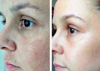 Máscara de argila Phytopeel remove manchas de acne e melasma